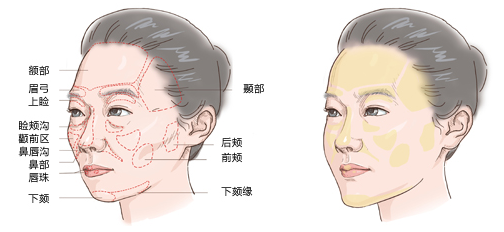 自體脂肪面部填充哪里較好呢