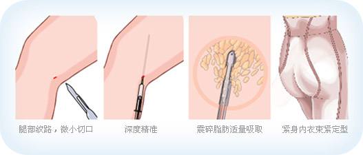 吸脂瘦腿手術(shù)后多長時間可以恢復(fù)呢