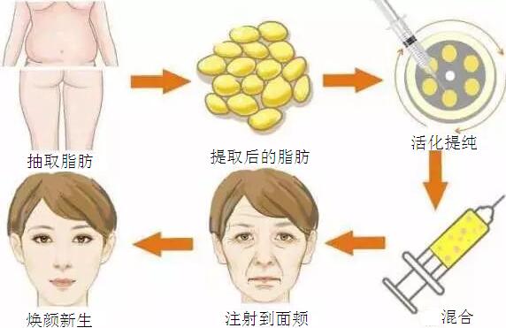 佛山的自體脂肪填充蘋果肌會(huì)有后遺癥嗎