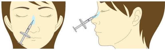 貴陽注射隆鼻的優(yōu)勢(shì)有哪些呢