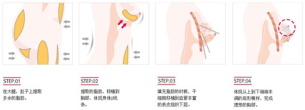 廣州做自體脂肪隆胸術(shù)后會不會出現(xiàn)胸部下垂的現(xiàn)象呢