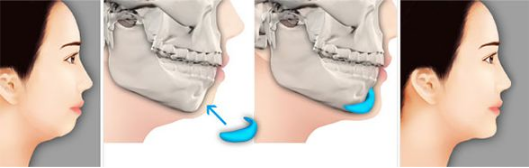 衡陽假體墊下巴術(shù)后會(huì)不會(huì)松弛