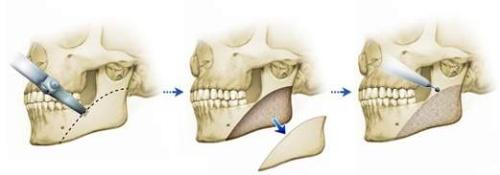 下頜角手術(shù)