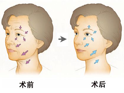 沈陽(yáng)做射頻除皺安全不安全嗎