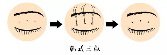 開(kāi)眼角手術(shù)