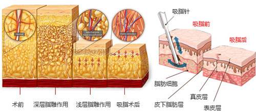 沈陽(yáng)做大腿吸脂對(duì)身體會(huì)不會(huì)有影響