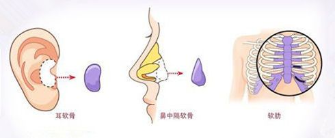 南京自體軟骨隆鼻的維持時(shí)間有多長(zhǎng)