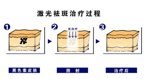 激光祛斑的價(jià)格