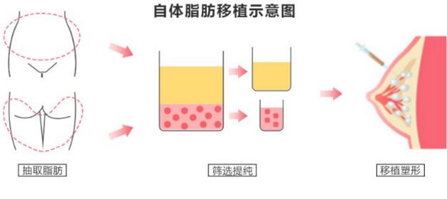 自體脂肪豐胸多久可以穩(wěn)定下來