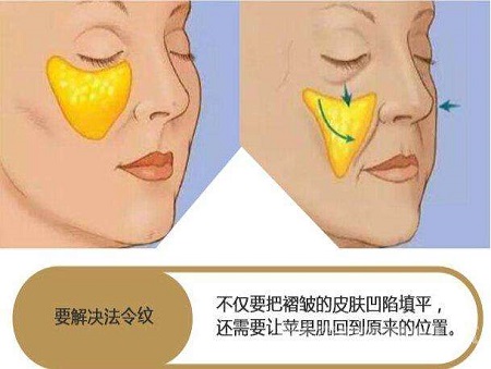 脂肪填充法令紋能維持多少時間？