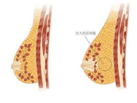 做自體脂肪豐胸手術(shù)會(huì)不會(huì)出現(xiàn)硬塊的現(xiàn)象