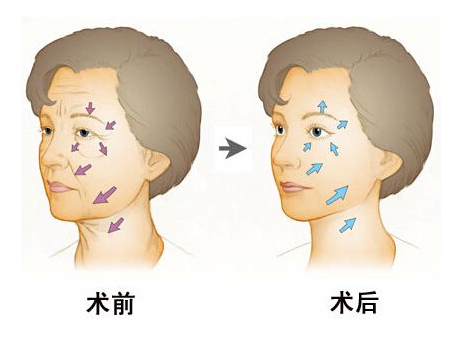 北京射頻除皺效果能保多久