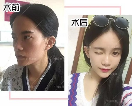 脂肪填一填，臉竟從“喪到爆”變“萌出血”！