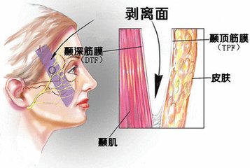 提升面部