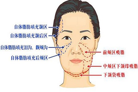 脂肪填充臉部