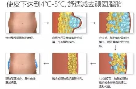 吸脂減肥