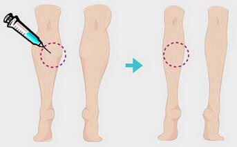 一針瘦腿多少錢？