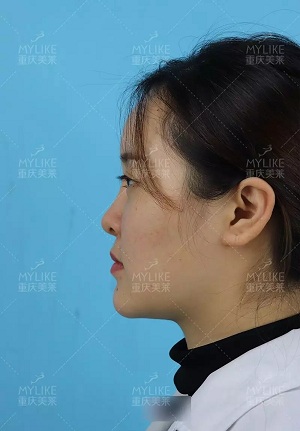 “鼻綜合”后假又歪，還攣縮？鼻修復(fù)還原自然生態(tài)美鼻