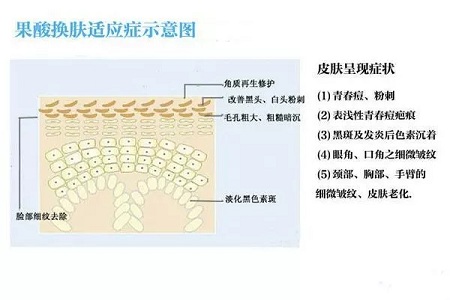 擠痘竟然被送進(jìn)ICU！你的痘痘還好嗎？