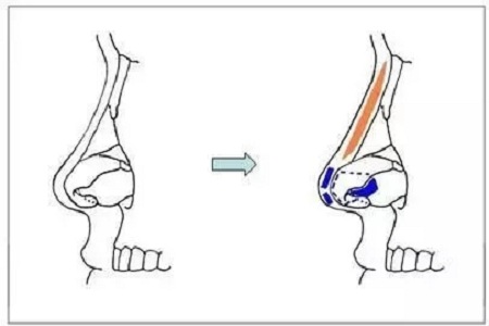 擔心鼻整形假體透光、發(fā)紅、移位？了解下自體軟骨