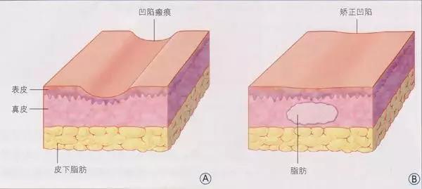 自體脂肪填充為什么需要二次補(bǔ)打？