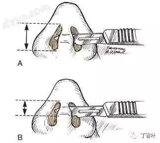 隆鼻手術切口在哪里？才能自然不留疤
