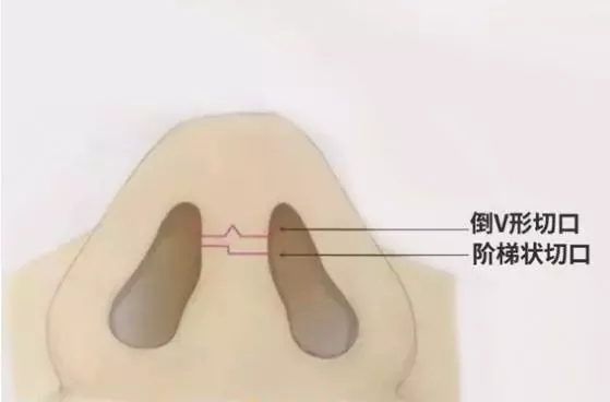 隆鼻手術切口在哪里？才能自然不留疤