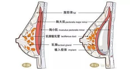 隆胸