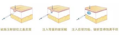 法令紋、川字紋