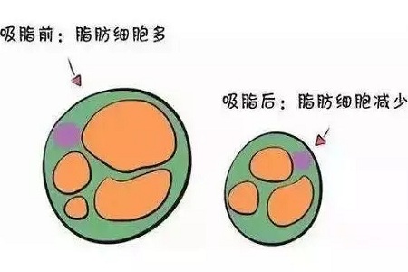 關于吸脂那些不能說的秘密，今天要在這里一次說完！