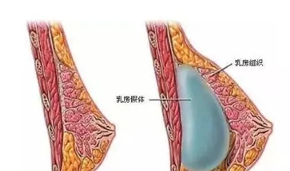 自體脂肪or假體隆胸，我到底應(yīng)該怎么選？