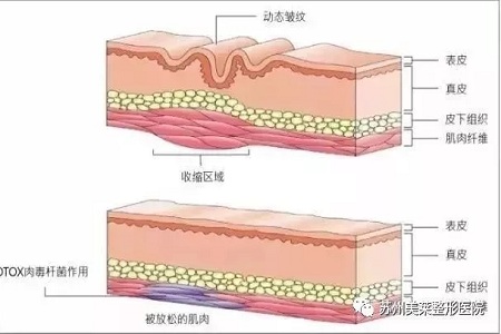 你無法用玻尿酸除掉所有皺紋！