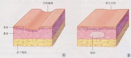 明星的臉和你的臉差的只是這一步！--面部脂肪填充