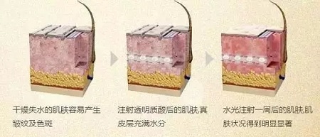 水光，打1次和4次究竟有多大區(qū)別？