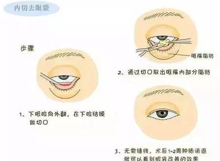 還把眼袋當(dāng)臥蠶？那就別怪小弟弟喊你阿姨了