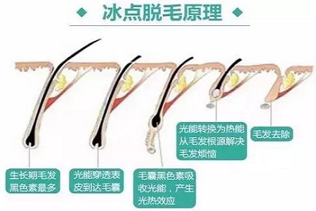 既便宜又安全的脫毛方法是什么？