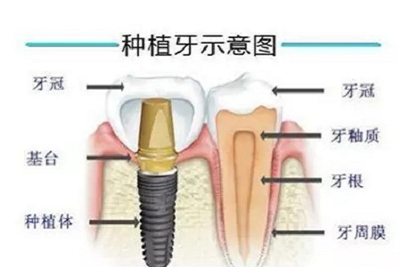 揭秘牙齒矯正的全過程?。?！