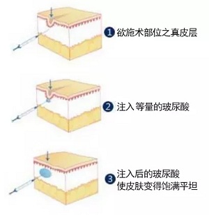 用玻尿酸治療鼻唇溝，一定要注意這種情況！