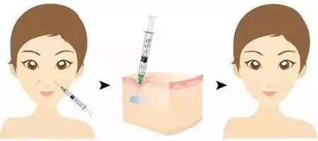 用玻尿酸治療鼻唇溝，一定要注意這種情況！