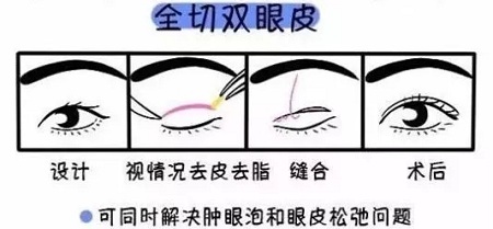 美眼張誠坐診美萊，淺談為什么你的眼睛不夠美？