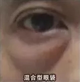 混合型眼袋