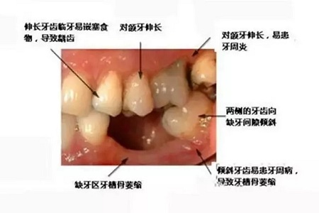 牙齒缺失時(shí)，選烤瓷牙還是那種？