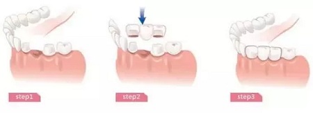 牙齒缺失時(shí)，選烤瓷牙還是那種？