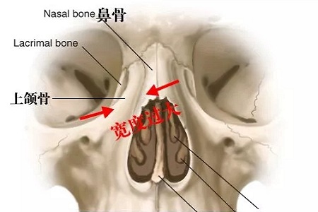 側(cè)面看鼻梁不矮,正面看鼻子卻很塌是什么原因？