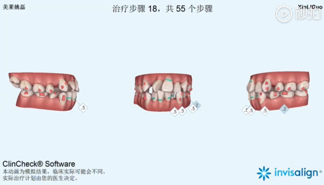 南京美萊口腔全景側(cè)位片，拍照取模，動畫方案設(shè)計