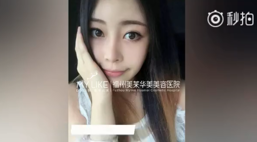 福州美萊鼻子幾毫米的改變，自信百倍的蛻變