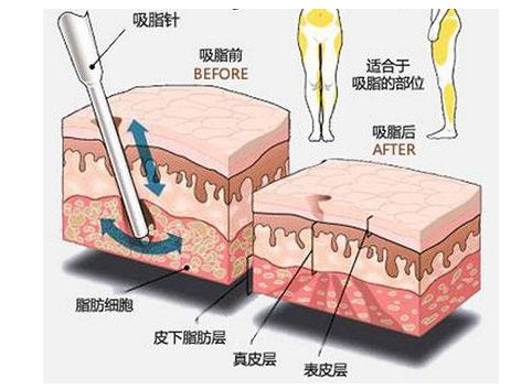 大腿吸脂