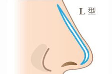 在廣州做假體隆鼻手術(shù)大概價格多少