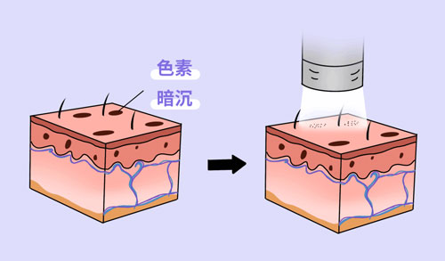 想要嫩膚，應(yīng)該選擇做光電還是水光