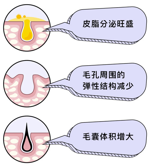 毛孔粗大怎么改善